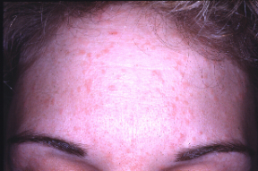 Hpv symptoms on face, Hpv skin face